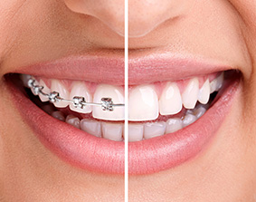 How To Look After Your Fixed Braces