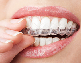 Removable Retainers